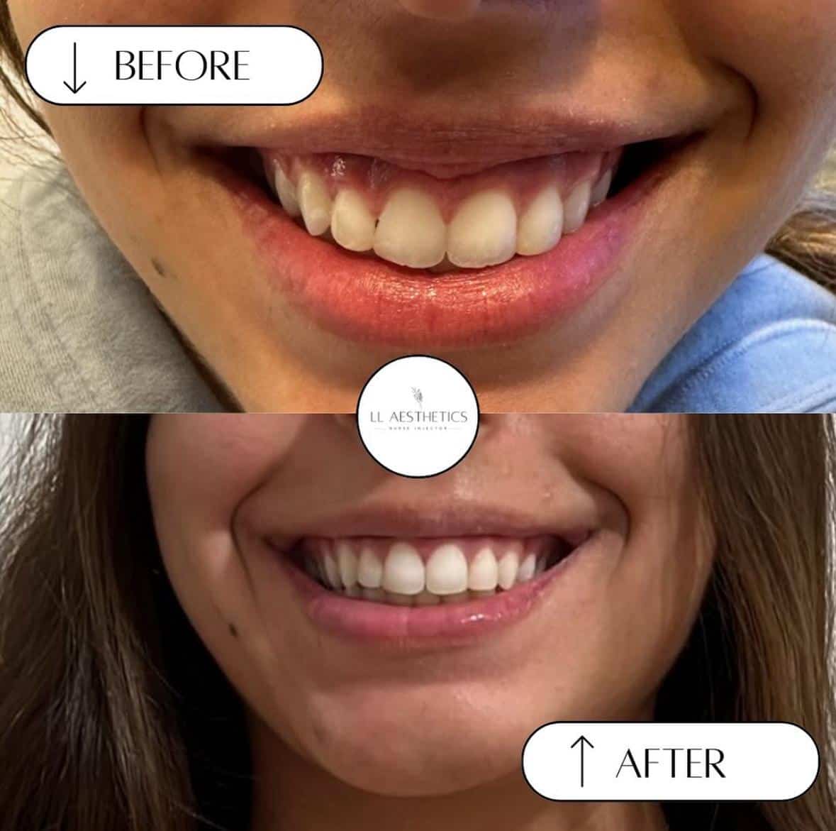 Dyspot treatment Before and after Weymouth, MA