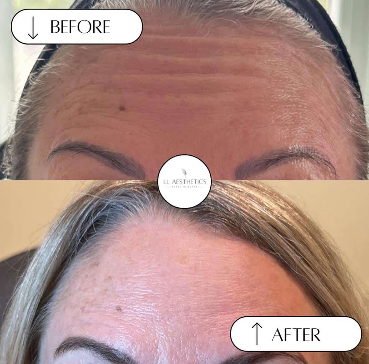 Botox treatment Before and after Weymouth, MA