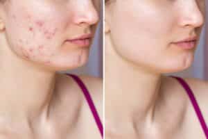 Before and after of a woman's acne scars after receiving IPL treatment